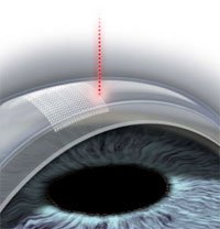 Surgical procedure to reshape the cornea with excimer laser